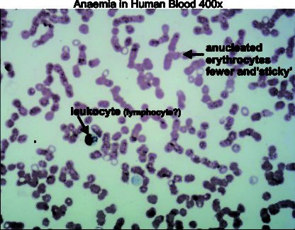 Human blood anaemia 400x